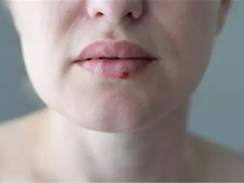حبوب الشفاه.. متى تكون علامة على قرحة البرد؟