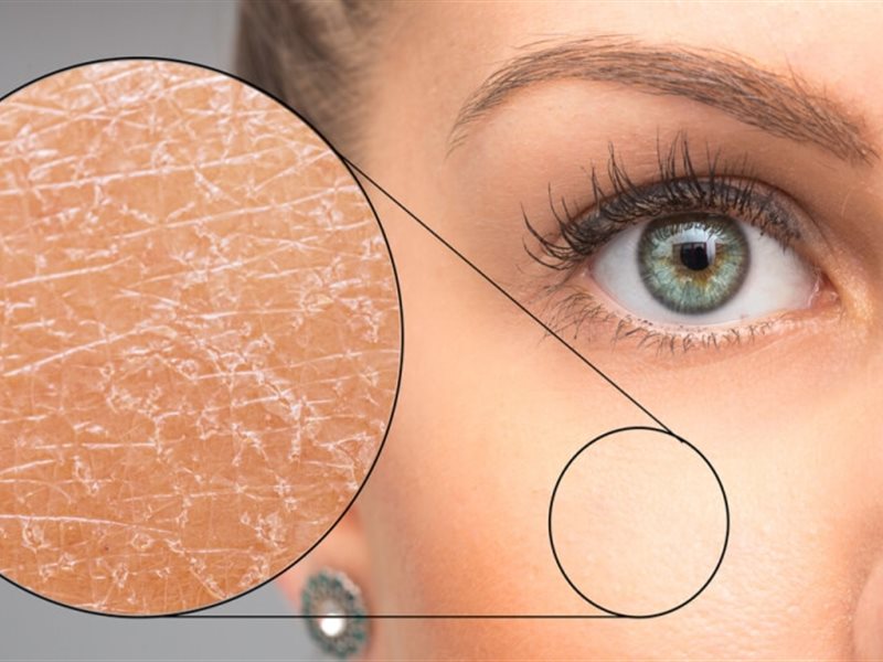 أسباب ظهور بقع جافة على بشرتك.. هل هي علامة على مشكلة مرضية؟  