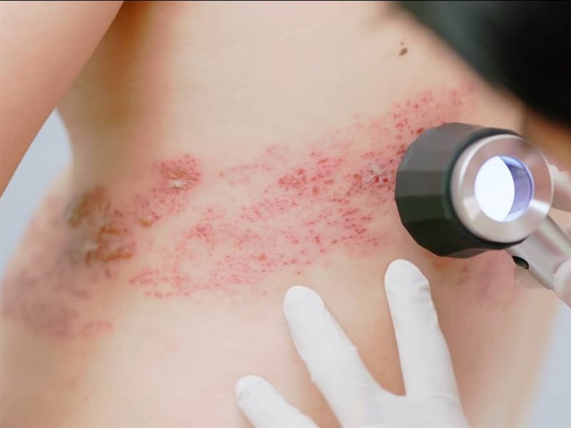 فئات معرضة للحزام الناري.. هل للتوتر دور في ذلك؟