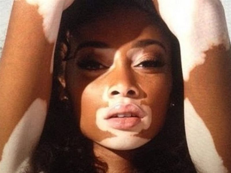 في اليوم العالمي للبهاق.. فئات أكثر عرضة للإصابة به وهذه أسبابه 