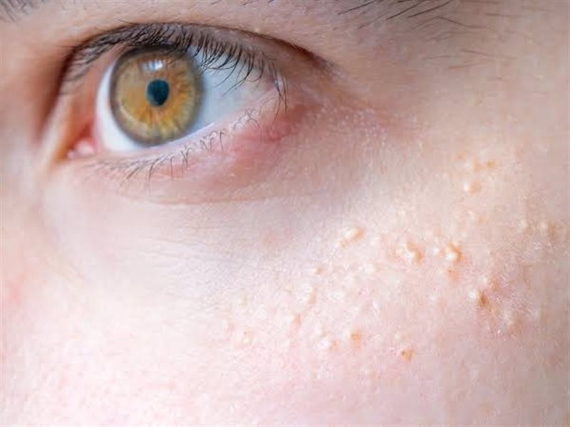 ليست حب شباب: كل ما تحتاج معرفته عن الميليا وكيفية التخلص منها 