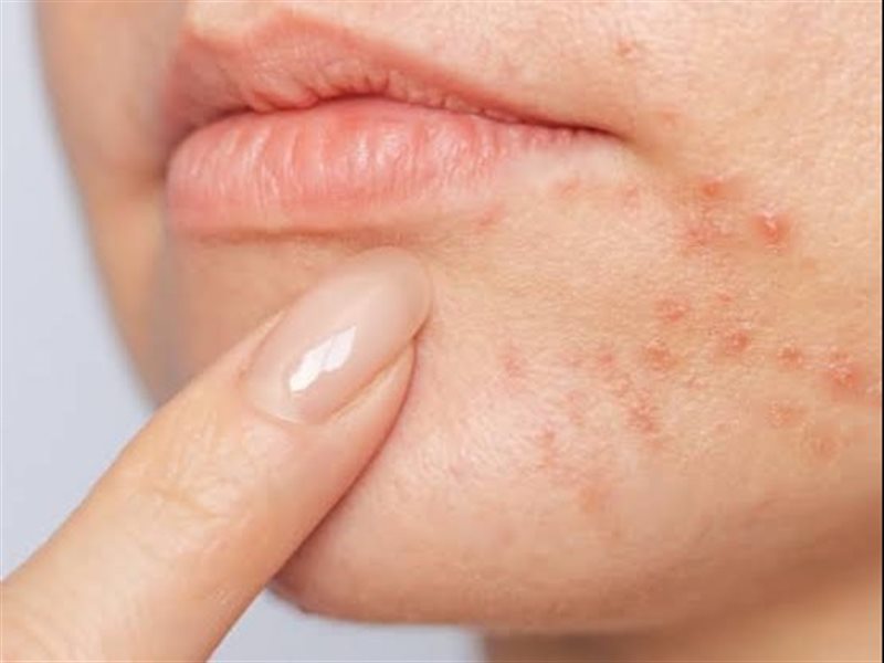  التهاب الجلد حول الفم.. الحالة الجلدية التي أصبحت حديث الجميع 