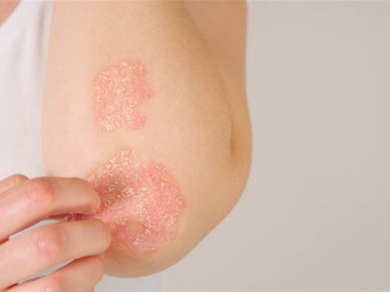 في الشهر العالمي للتوعية بالصدفية.. إليك كل ما تريد معرفته عن المرض؟ 