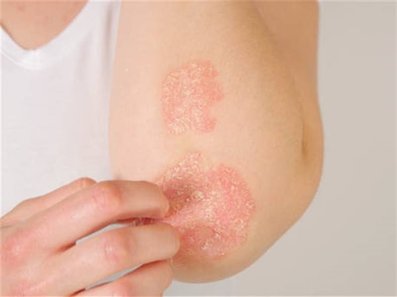 في الشهر العالمي لمرض الصدفية.. فئات أكثر عرضة للإصابة